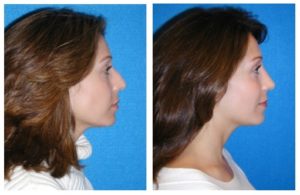 Sacramento Rhinoplasty Before and After