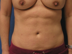 Liposuction