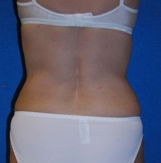 Liposuction