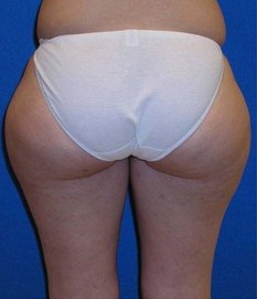 Liposuction