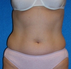 Liposuction