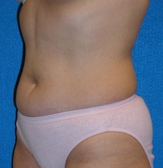 Liposuction