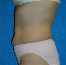 Liposuction