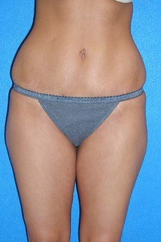 Liposuction