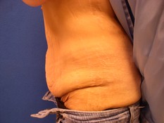 Post Bariatric Surgery