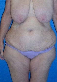 Post Bariatric Surgery