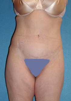 Post Bariatric Surgery