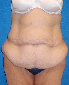 Post Bariatric Surgery