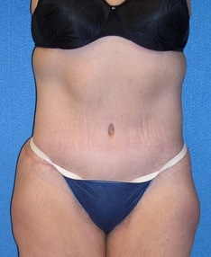 Post Bariatric Surgery