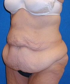 Post Bariatric Surgery