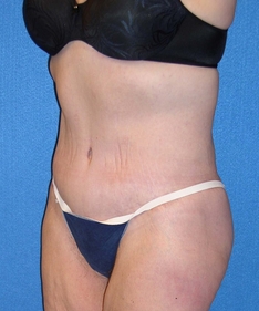 Post Bariatric Surgery