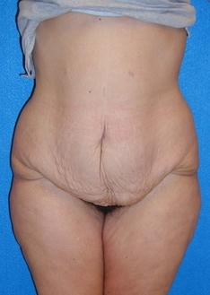 Post Bariatric Surgery