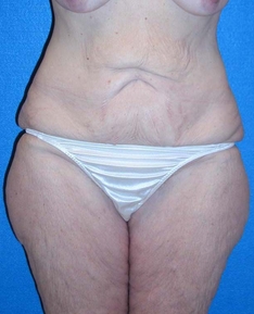 Post Bariatric Surgery