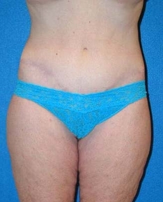 Post Bariatric Surgery