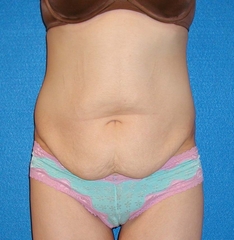 Post Bariatric Surgery