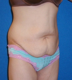 Post Bariatric Surgery