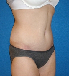 Post Bariatric Surgery