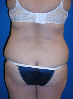 Tummy Tuck