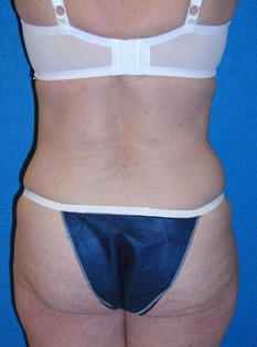 Tummy Tuck