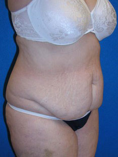 Tummy Tuck