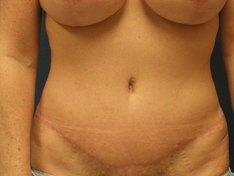 Tummy Tuck