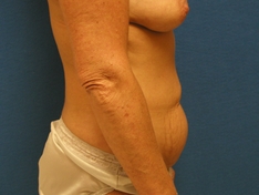 Tummy Tuck