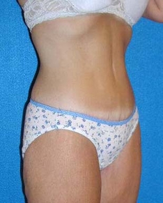 Tummy Tuck