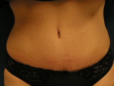 Tummy Tuck