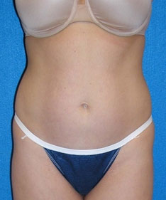 Tummy Tuck