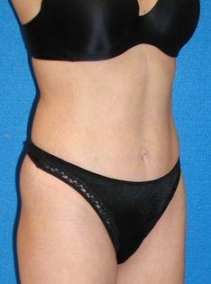 Tummy Tuck