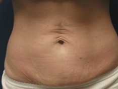 Tummy Tuck