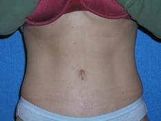 Tummy Tuck