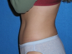 Tummy Tuck