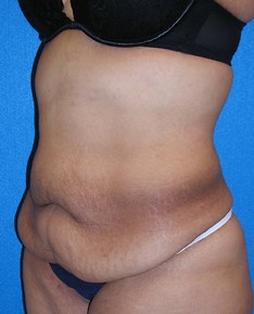 Tummy Tuck