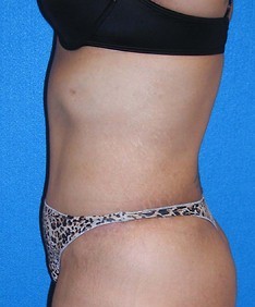 Tummy Tuck