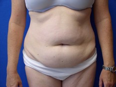 Tummy Tuck