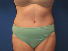 Tummy Tuck