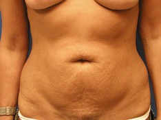 Tummy Tuck