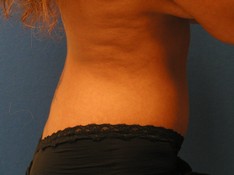 Tummy Tuck