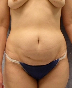 Tummy Tuck