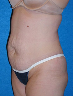 Tummy Tuck