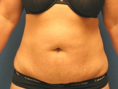 Tummy Tuck