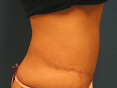 Tummy Tuck