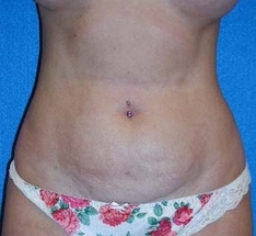 Tummy Tuck