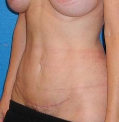 Tummy Tuck