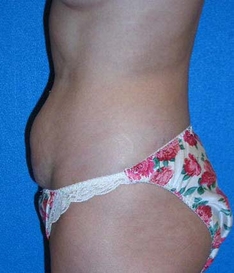 Tummy Tuck