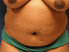 Tummy Tuck