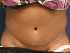 Tummy Tuck