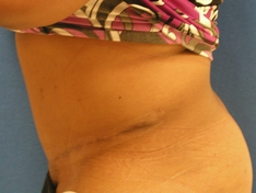 Tummy Tuck