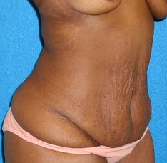 Tummy Tuck